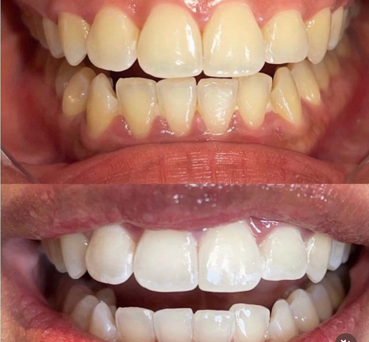Result 01 — Before and after teeth whitening treatment, shown side by side