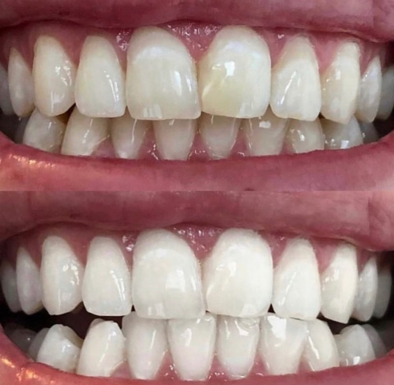 Result 02 — Before and after teeth whitening treatment, shown side by side