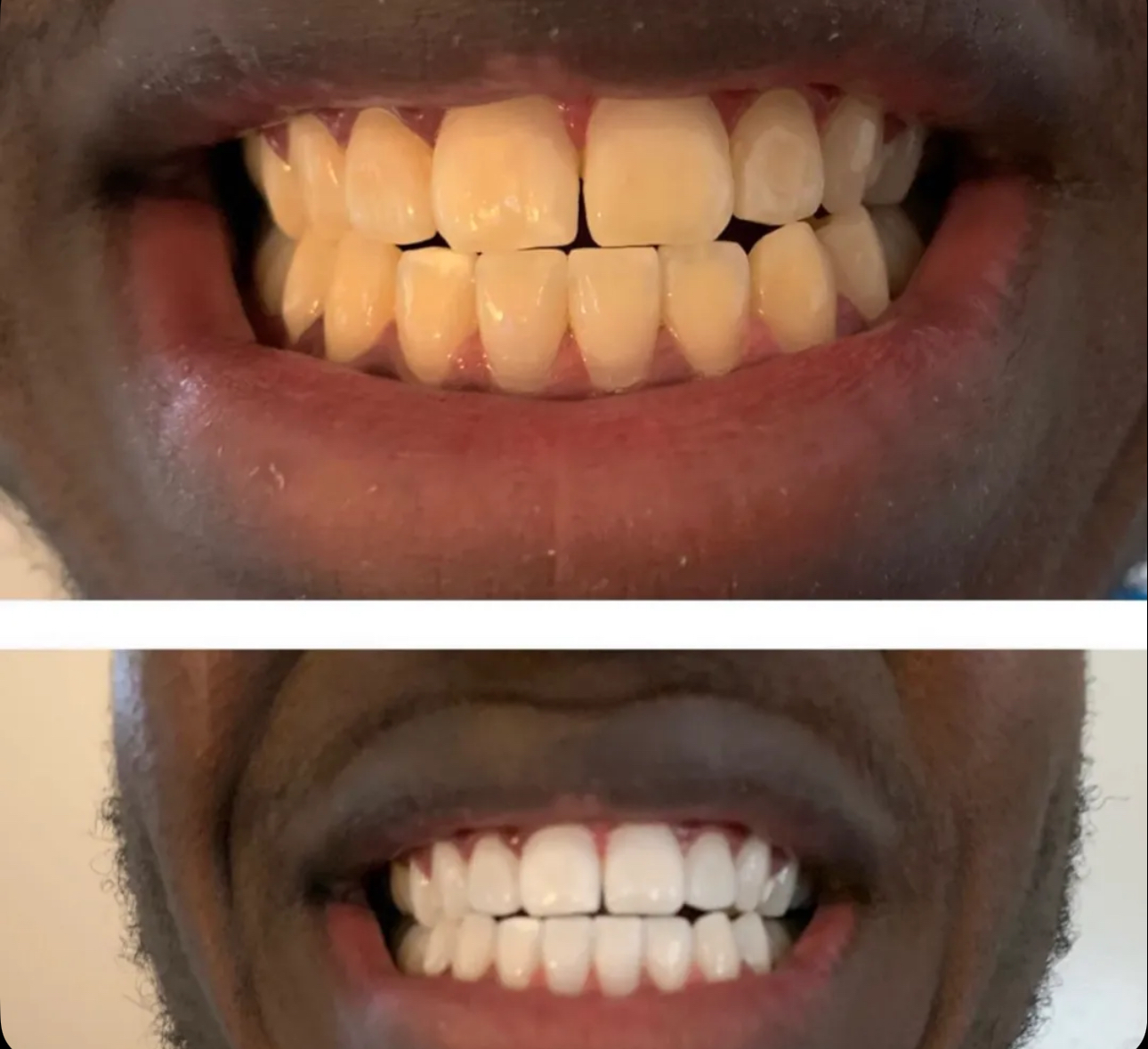 Result 03 — Before and after teeth whitening treatment, shown side by side