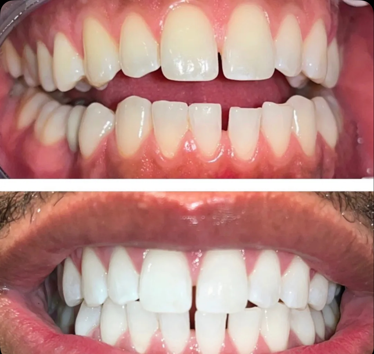 Result 04 — Before and after teeth whitening treatment, shown side by side
