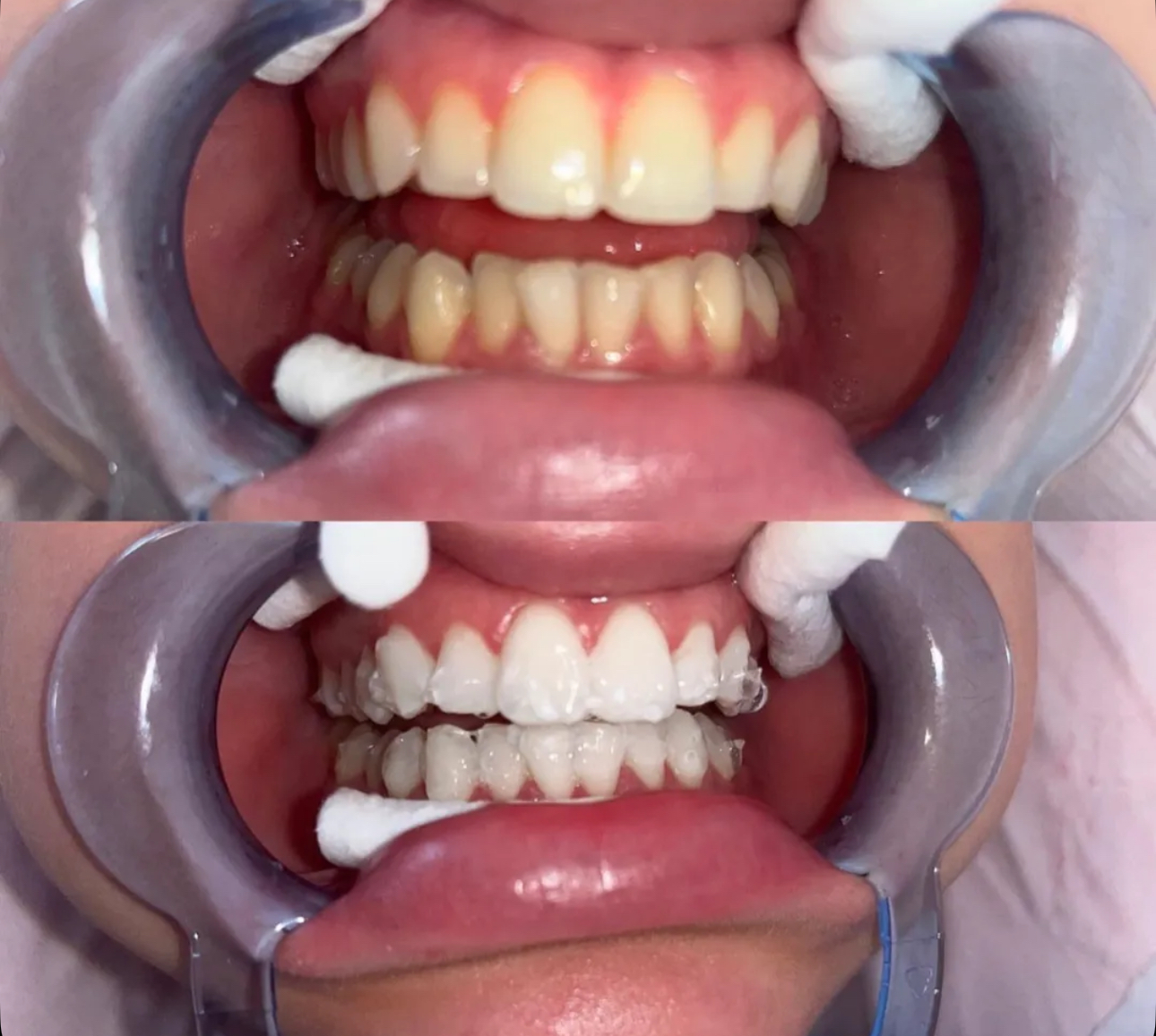 Result 05 — Before and after teeth whitening treatment