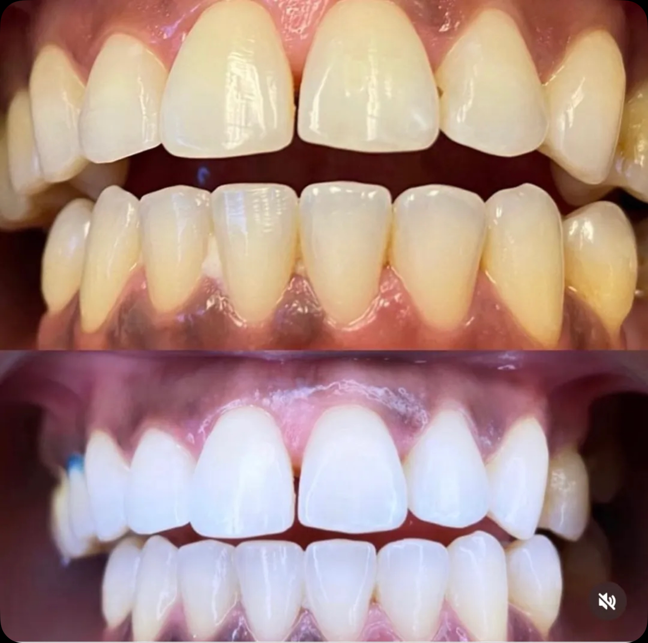 Result 06 — Before and after teeth whitening treatment