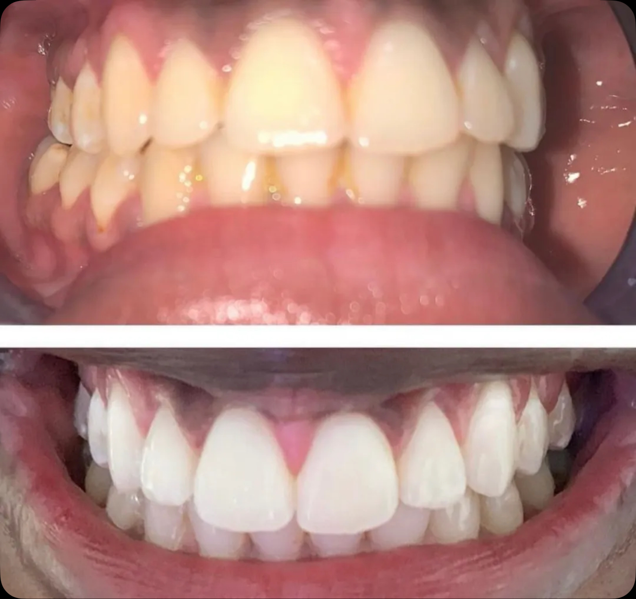 Result 07 — Before and after teeth whitening treatment