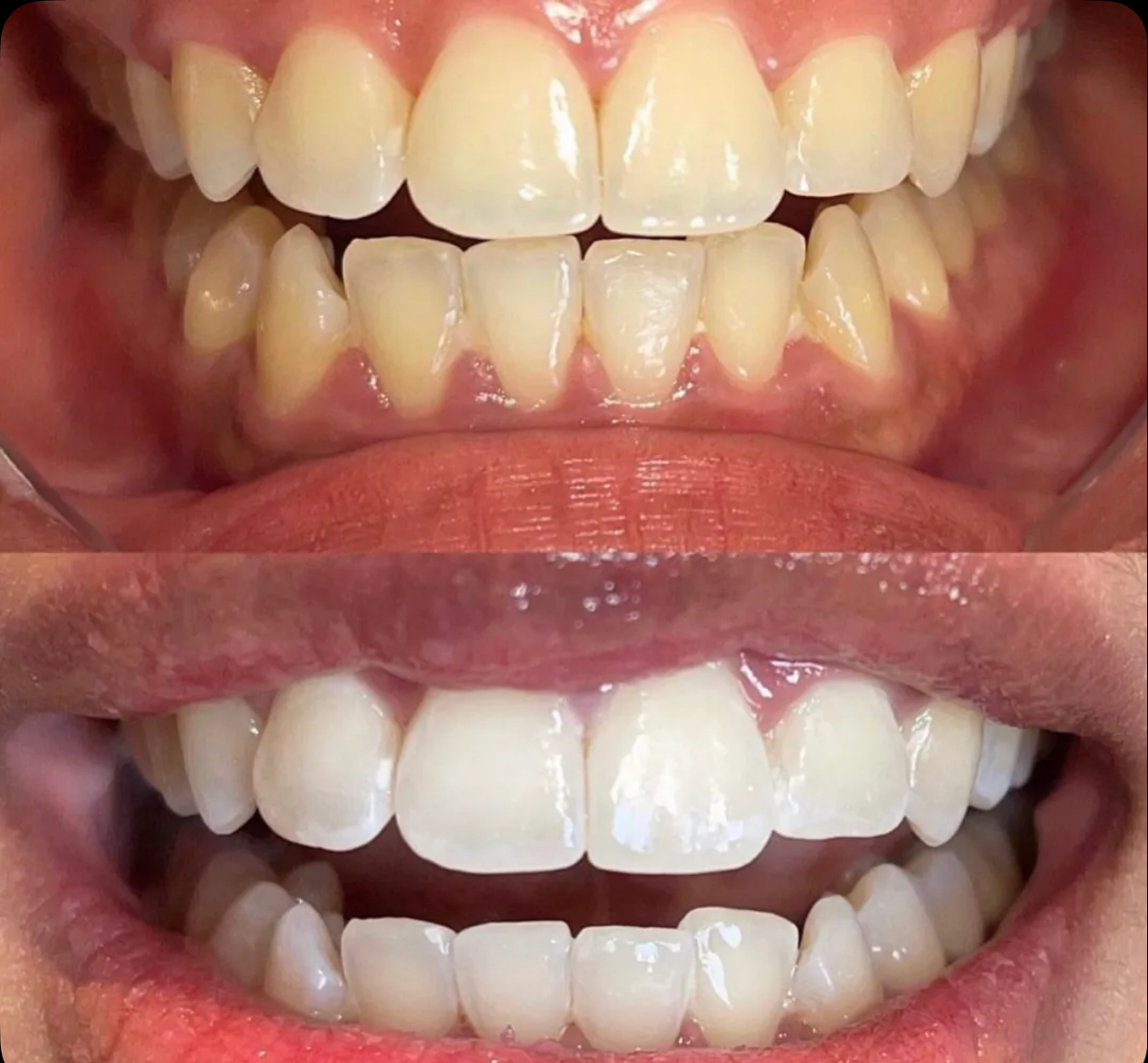 Result 08 — Before and after teeth whitening treatment